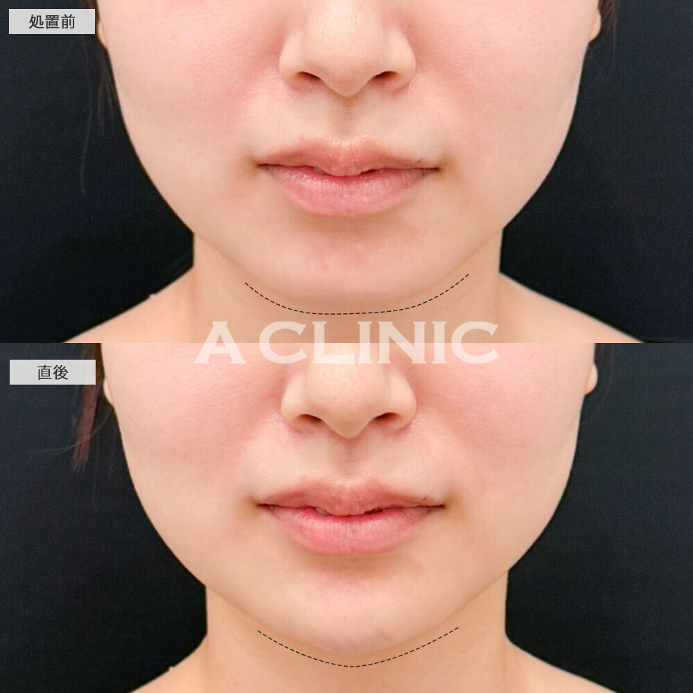 あごへのヒアルロン酸注入でぼやけていた輪郭がくっきりしました！こちら処置前と直後の症例です(20代女性)