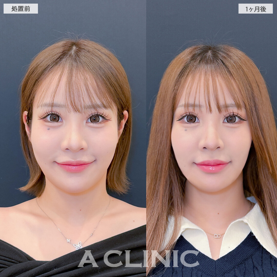 Aスレッドと小顔エラボトックスで気になるエラの張りがスッキリしました！こちら処置前と1ヶ月後の症例です(20代女性)