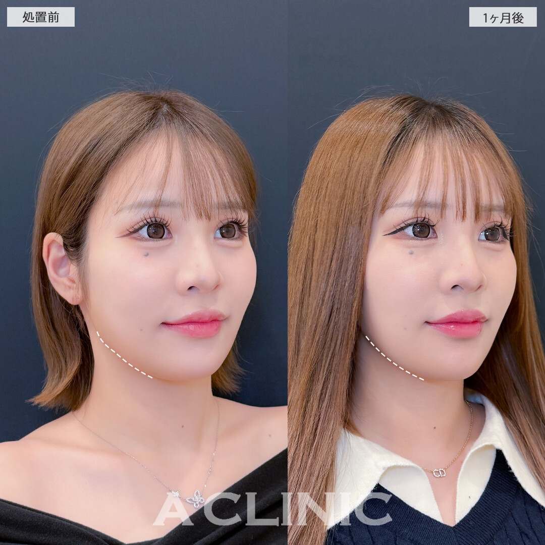 Aスレッドと小顔エラボトックスで気になるエラの張りがスッキリしました！こちら処置前と1ヶ月後の症例です(20代女性)