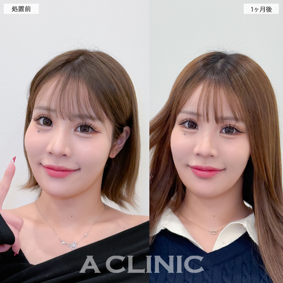Aスレッドと小顔エラボトックスで気になるエラの張りがスッキリしました！こちら処置前と1ヶ月後の症例です(20代女性)