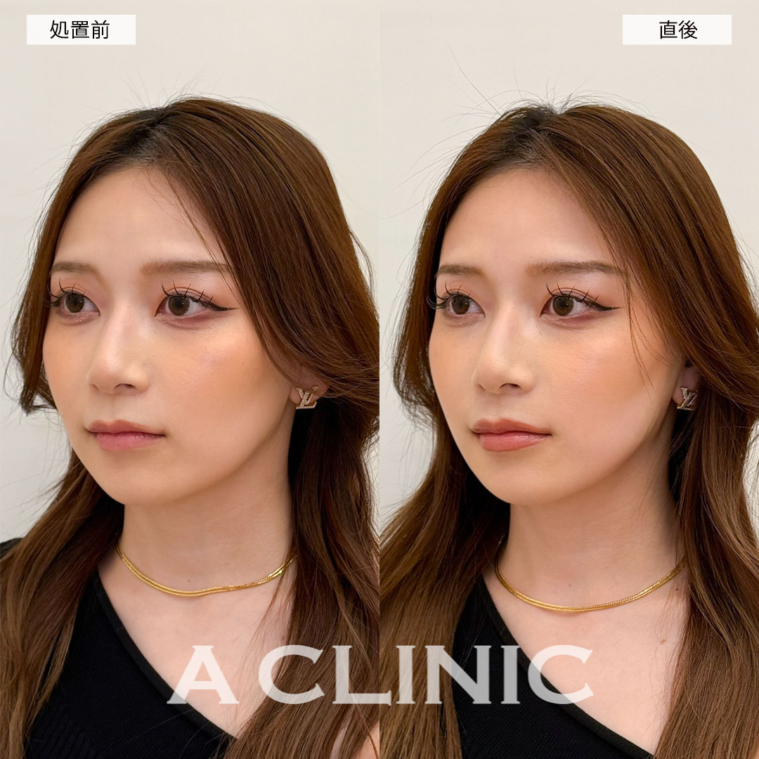 Aスレッドで即日リフトアップし可愛さ倍増！こちら処置前と直後の症例です(20代女性)