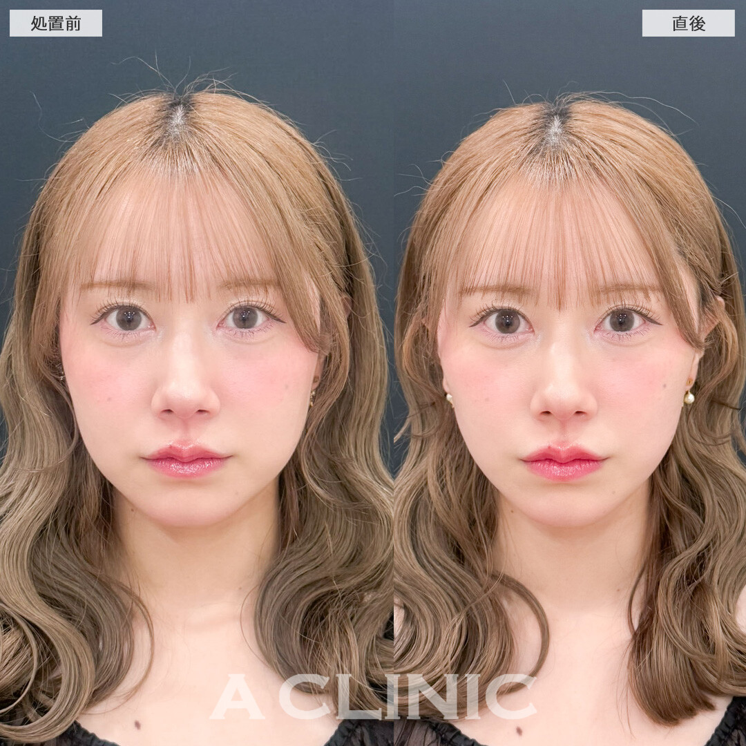 Aスレッドは短時間で垢抜けが叶います！こちら処置前と直後の症例です(30代女性)
