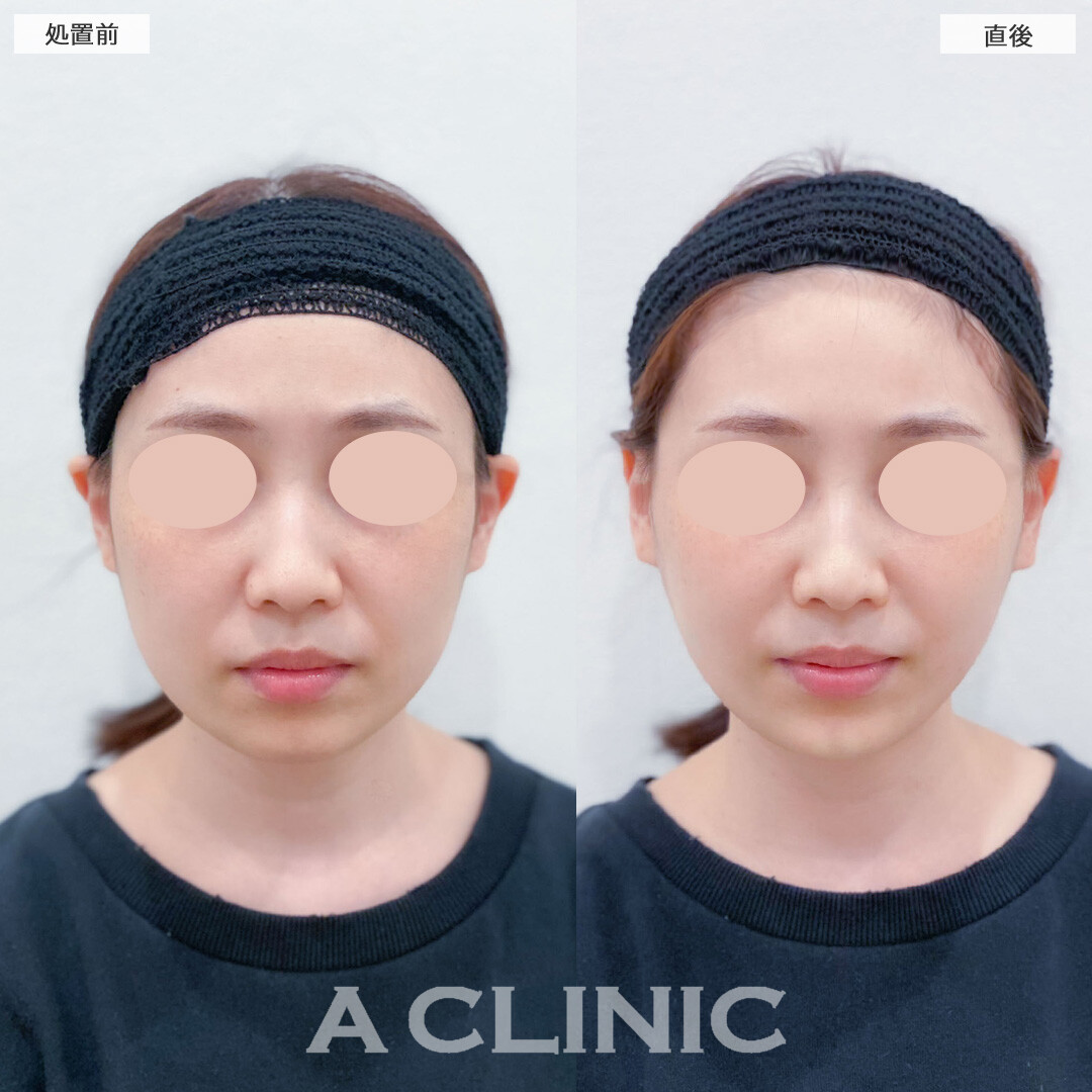 Aスレッドとあごへのヒアルロン酸注入で直後から輪郭が綺麗に整いました！こちら処置前と直後の症例です(20代女性)