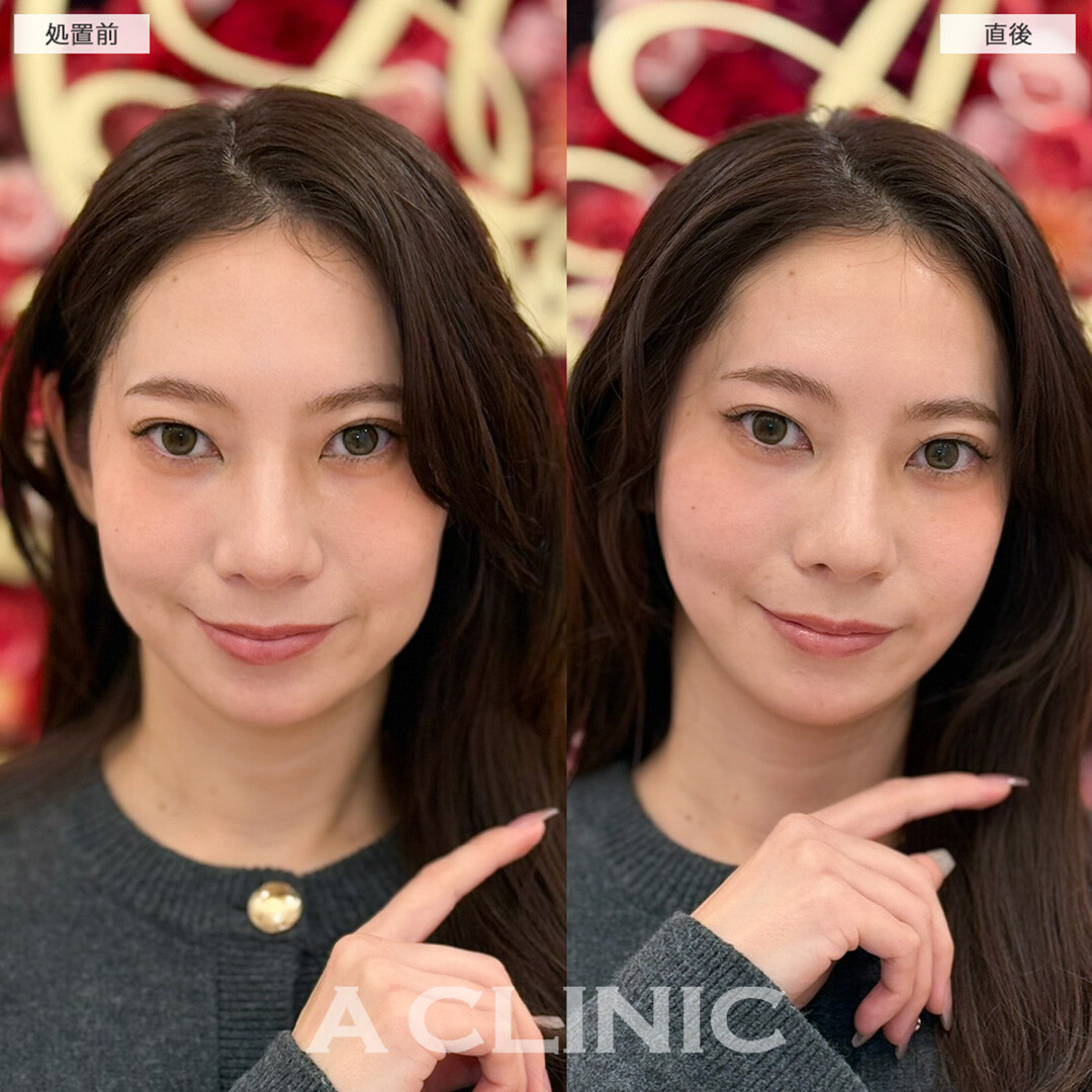 Aスレッドで痩せコケた頬のお悩み解消へ！処置前と直後の症例です(30代女性)