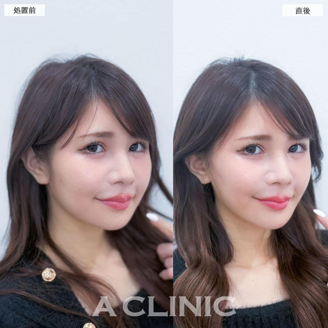 Aスレッドでフェイスラインをしっかり引き上げ直後から理想のVフェイスになりました！こちら処置前と直後の症例です(30代女性)