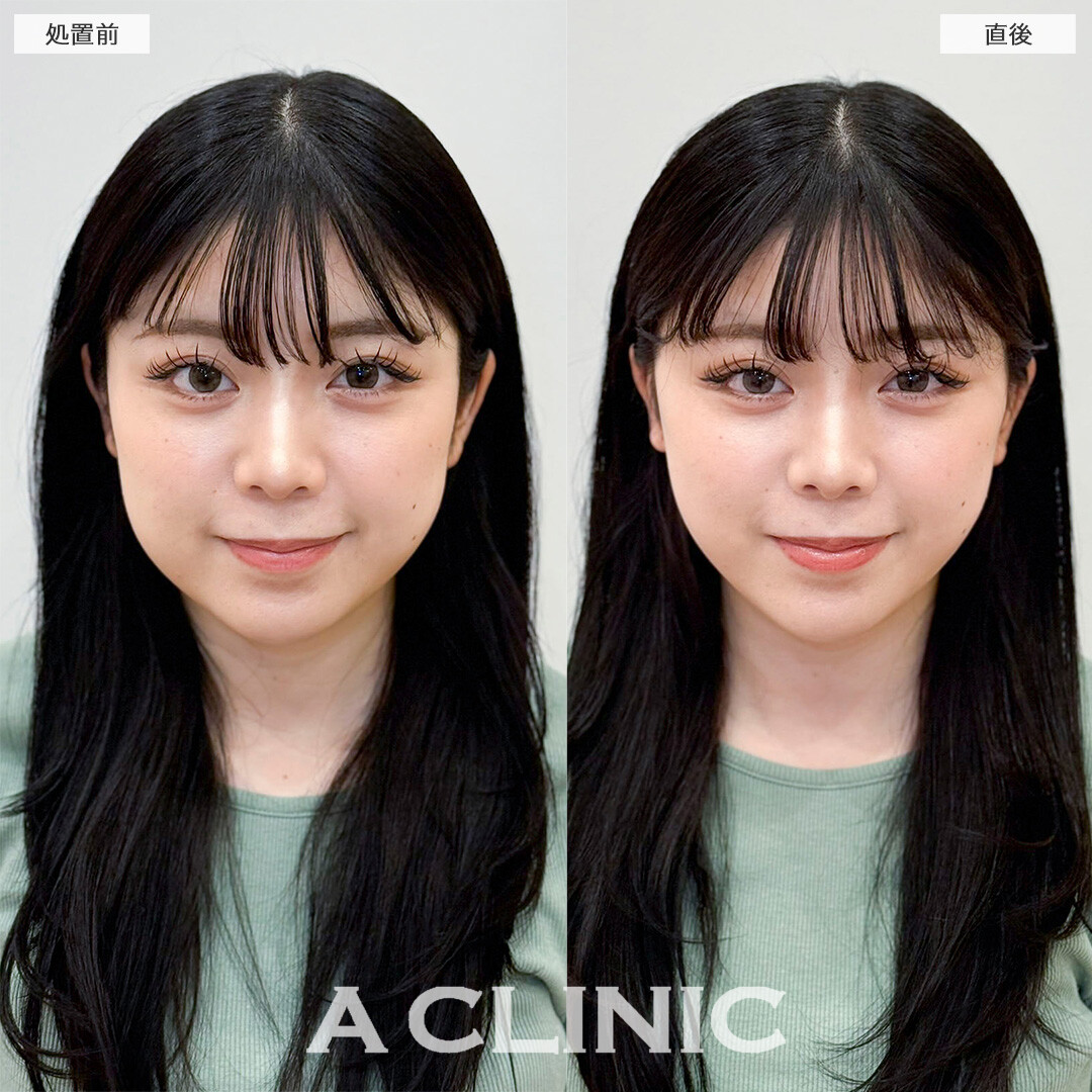 Aスレッドで丸顔からVフェイスに変化！処置前と直後の症例です(20代女性)