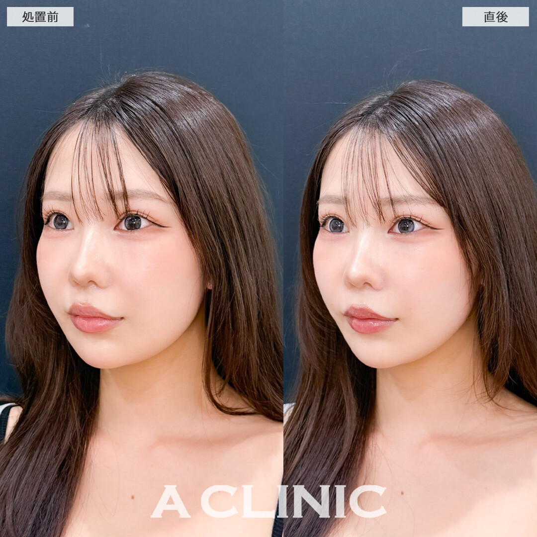 Aスレッドとヒアルロン酸注射(シワ)でお疲れ顔も一気に復活します！こちら処置前と直後の症例です(20代女性)