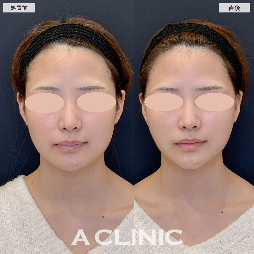 Aスレッドで憧れのV字フェイス手に入れました！こちら処置前と直後の症例です(20代女性)