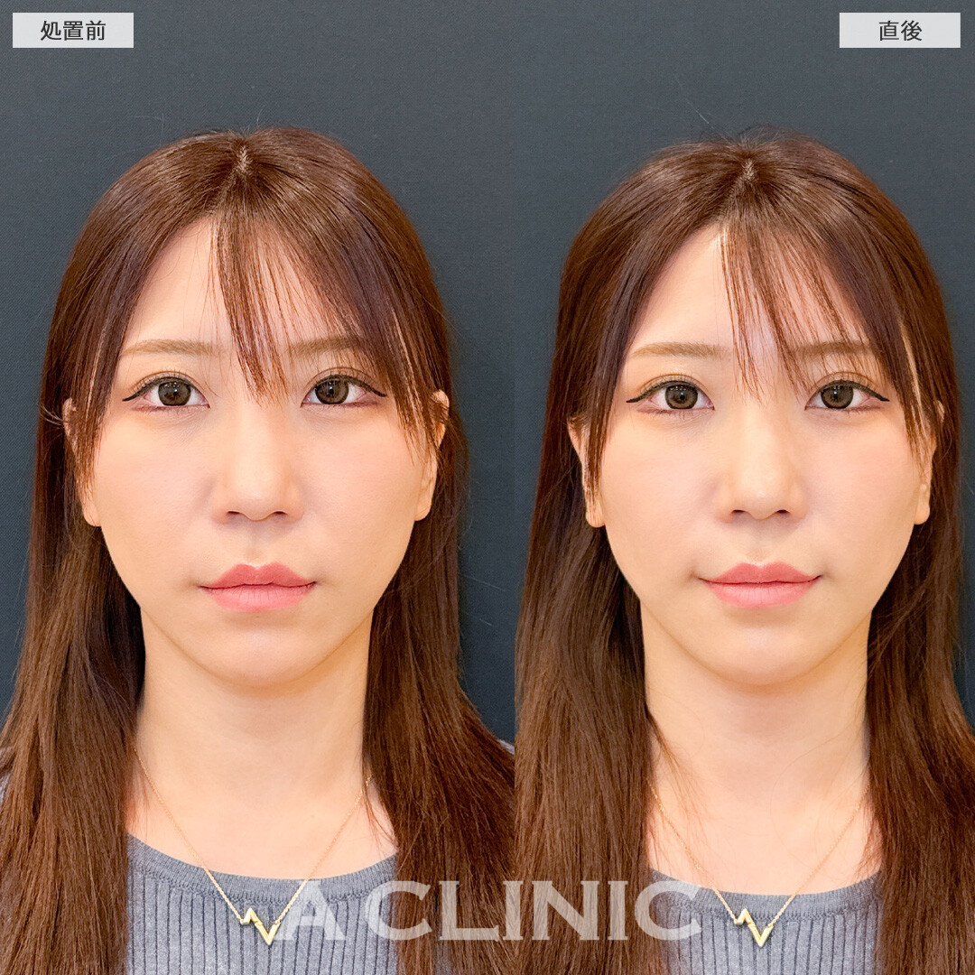Aスレッドで気になり始めたお顔の下部分を引き上げます！こちら処置前と直後の症例です(30代女性)
