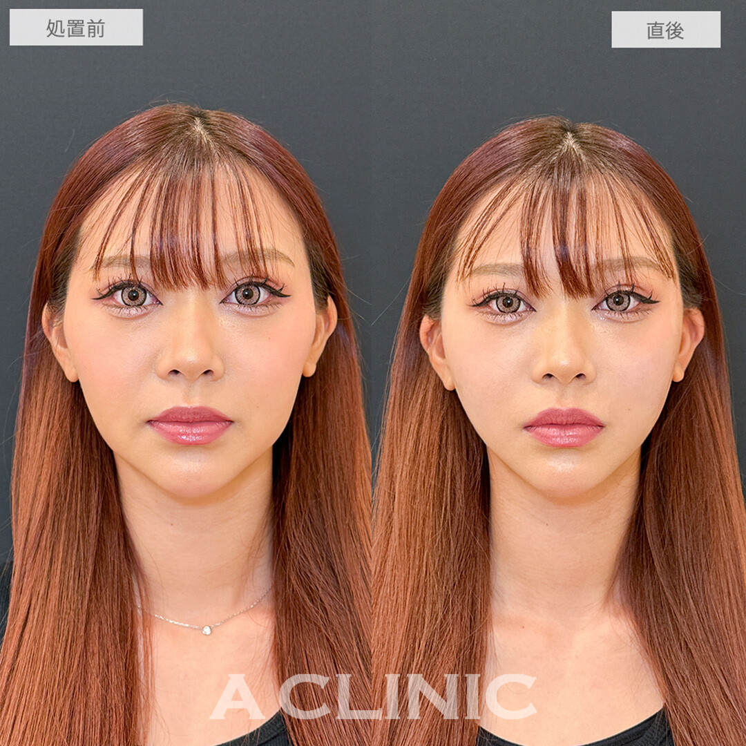 Aスレッドで中顔面短縮しつつほうれい線も解消！処置前と直後の症例です(20代女性)