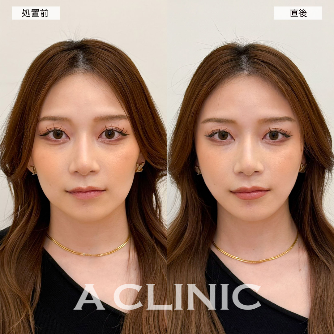 Aスレッドで即日リフトアップし可愛さ倍増！こちら処置前と直後の症例です(20代女性)