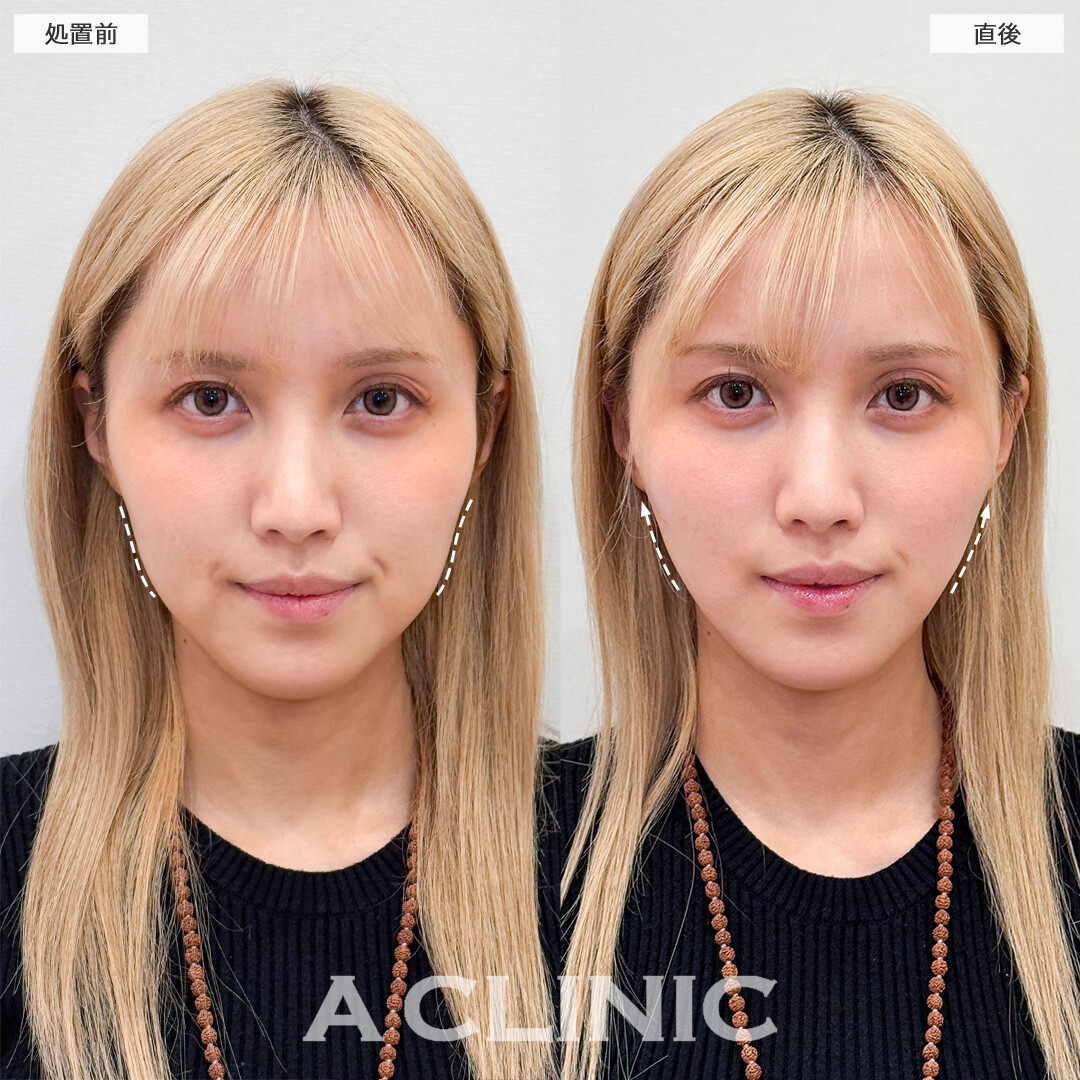 Aスレッドと頬へのヒアルロン酸注入で余分なたるみを引き上げ頬コケも改善！こちら処置前と直後の症例です(20代女性)