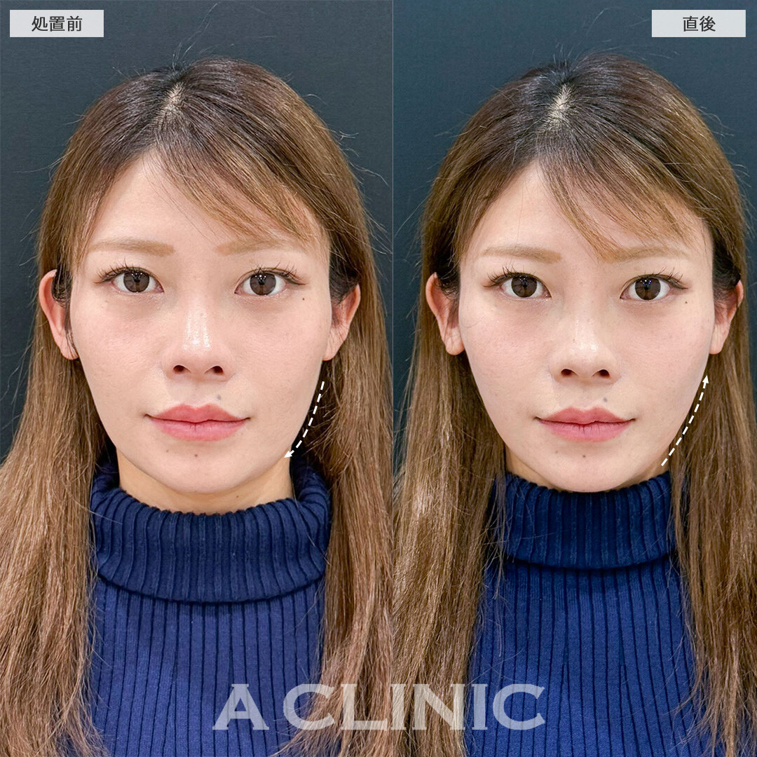 Aスレッドなら直後から腫れ最小限で下顔面のもたつき解消！こちら処置前と直後の症例です(30代女性)