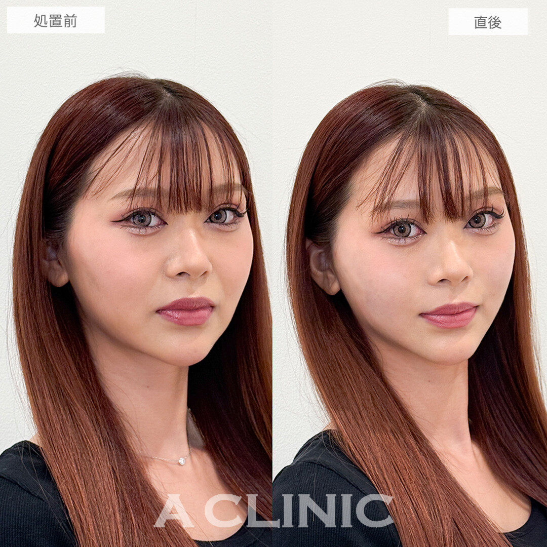 Aスレッドで中顔面短縮しつつほうれい線も解消！処置前と直後の症例です(20代女性)