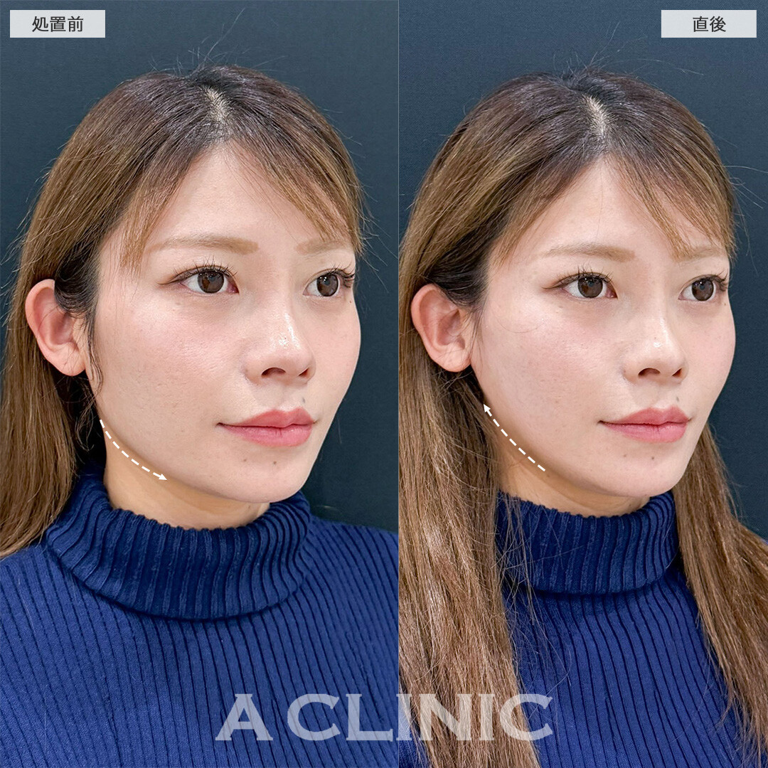 Aスレッドなら直後から腫れ最小限で下顔面のもたつき解消！こちら処置前と直後の症例です(30代女性)