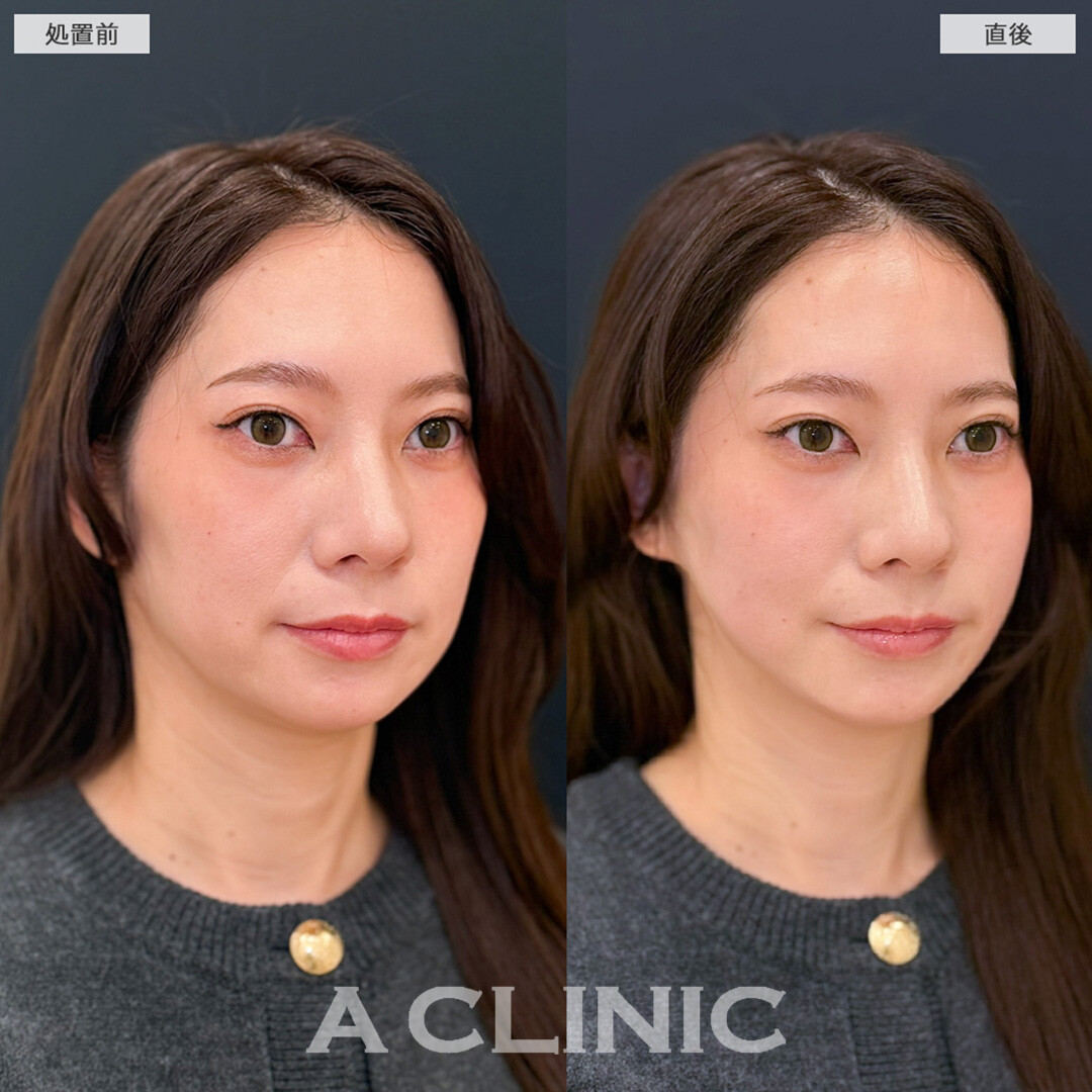 Aスレッドで痩せコケた頬のお悩み解消へ！処置前と直後の症例です(30代女性)