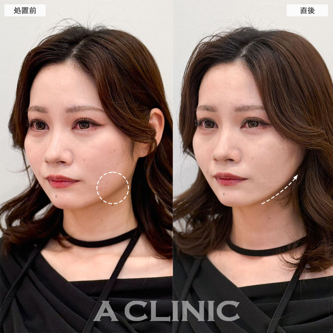 Aスレッドなら施術時間たった15分でフェイスラインのもたつき改善！こちら処置前と直後の症例です(30代女性)