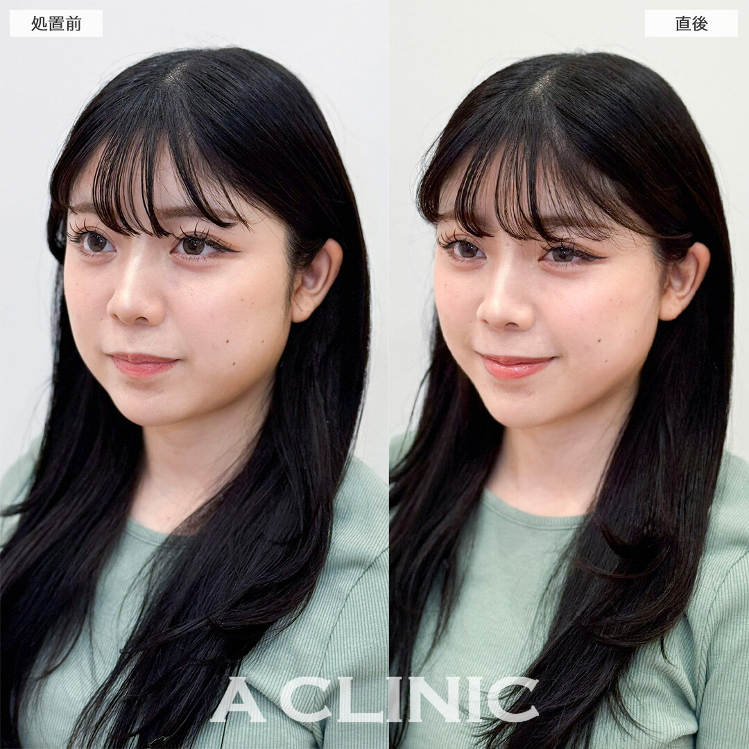 Aスレッドで丸顔からVフェイスに変化！処置前と直後の症例です(20代女性)