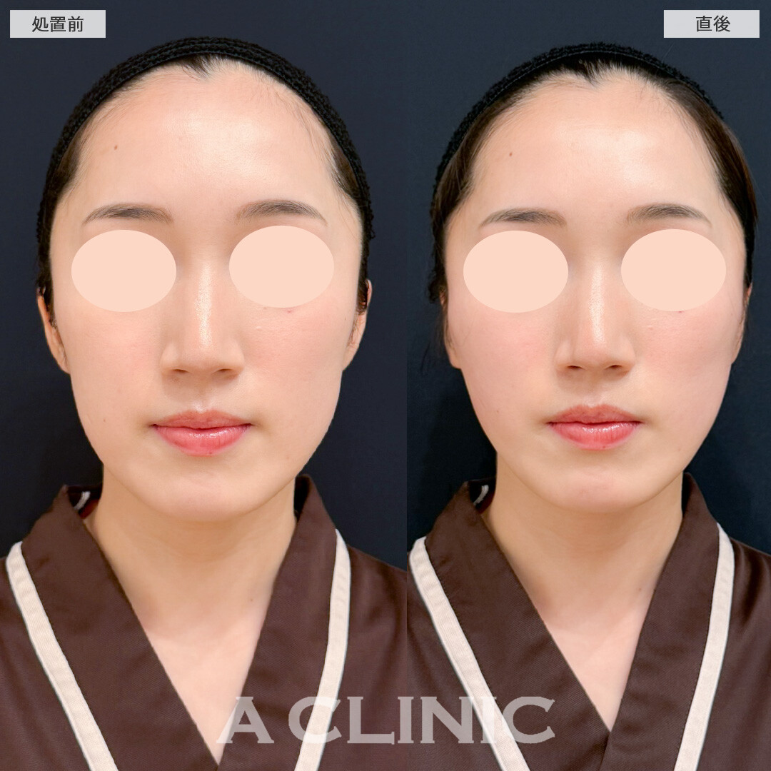 Aスレッドで輪郭の凹凸を減らしてまっすぐシャープなフェイスラインになりました！処置前と直後の症例です(20代女性)
