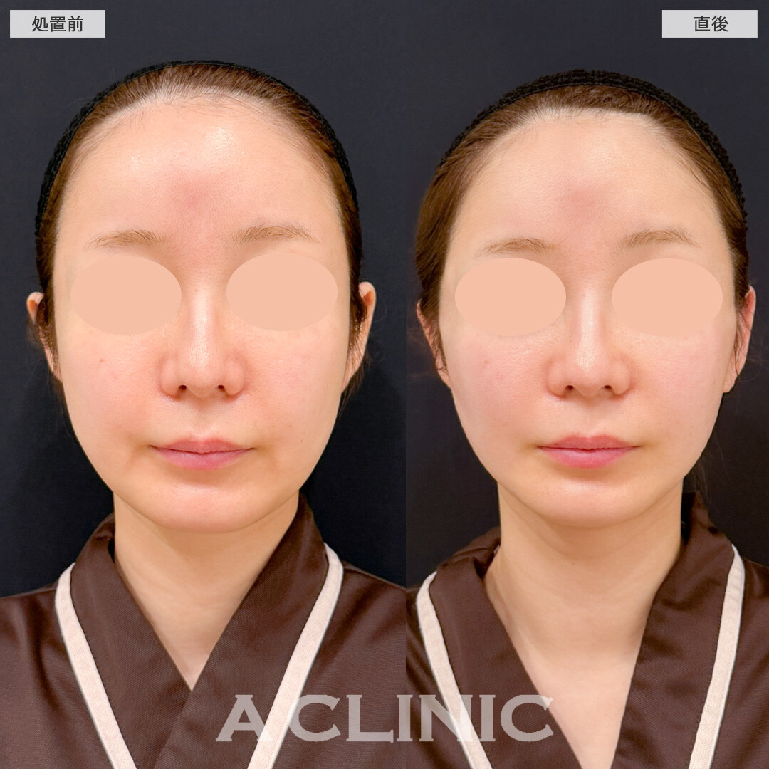 Aスレッドで不自然にならずに丸みのある小顔にもなれちゃいます！処置前と直後の症例です(30代女性)