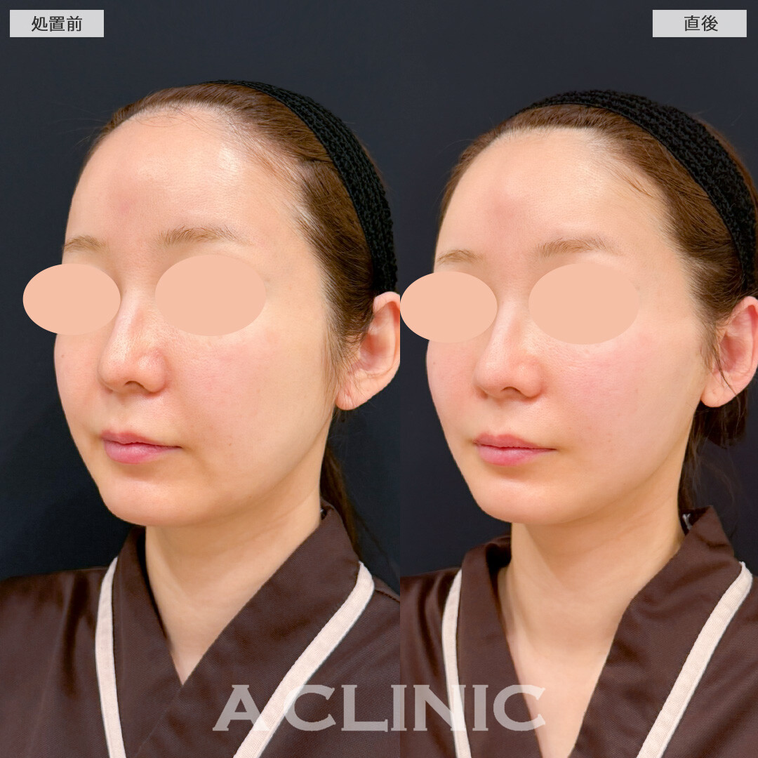 Aスレッドで不自然にならずに丸みのある小顔にもなれちゃいます！処置前と直後の症例です(30代女性)