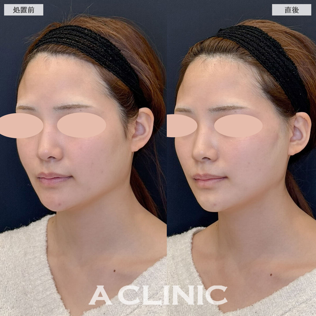 Aスレッドで憧れのV字フェイス手に入れました！こちら処置前と直後の症例です(20代女性)