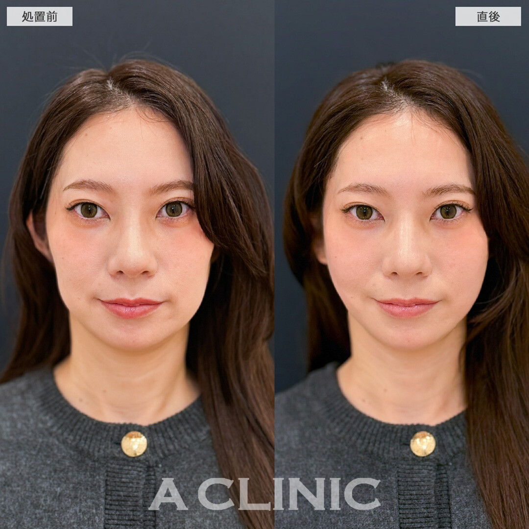 Aスレッドで痩せコケた頬のお悩み解消へ！処置前と直後の症例です(30代女性)