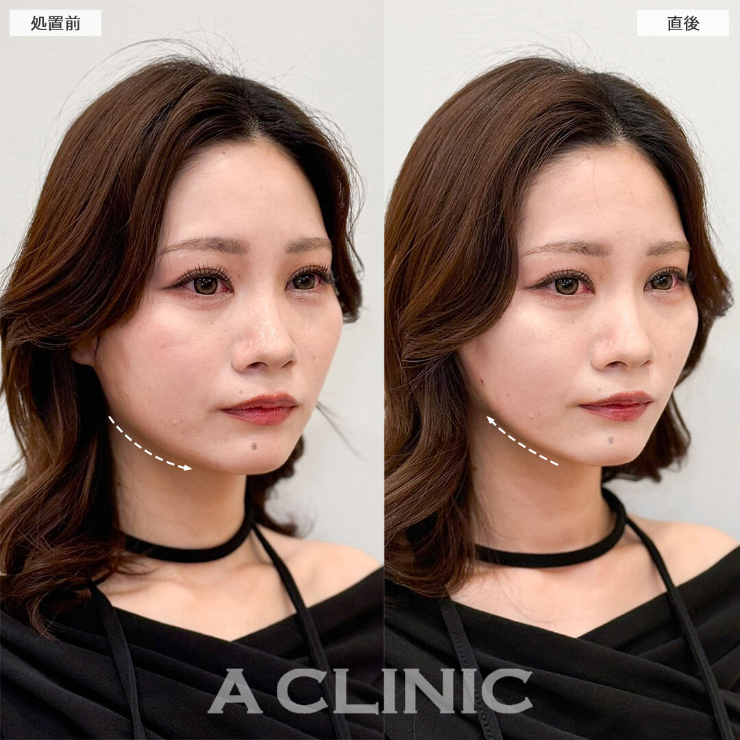 Aスレッドなら施術時間たった15分でフェイスラインのもたつき改善！こちら処置前と直後の症例です(30代女性)