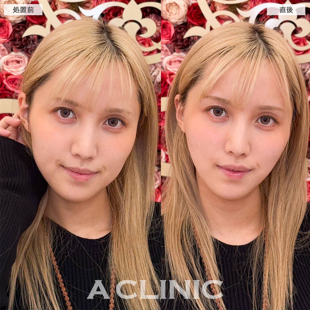 Aスレッドと頬へのヒアルロン酸注入で余分なたるみを引き上げ頬コケも改善！こちら処置前と直後の症例です(20代女性)