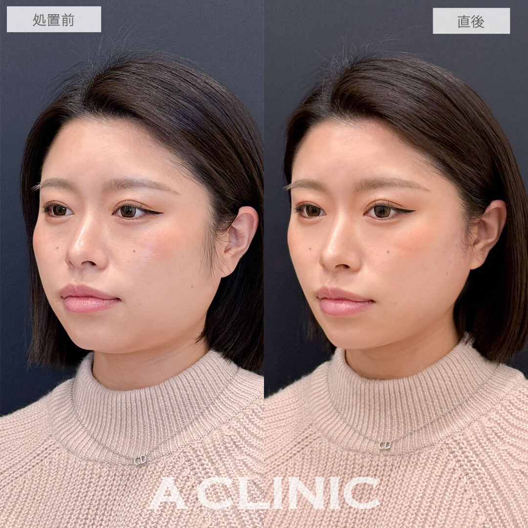 Aスレッドで憧れのVフェイス目指せます！こちら処置前と直後の症例です(20代女性)