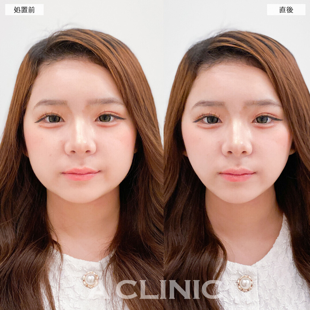 Aスレッドは将来のたるみ予防にも効果的！こちら処置前と直後の症例です(10代女性)