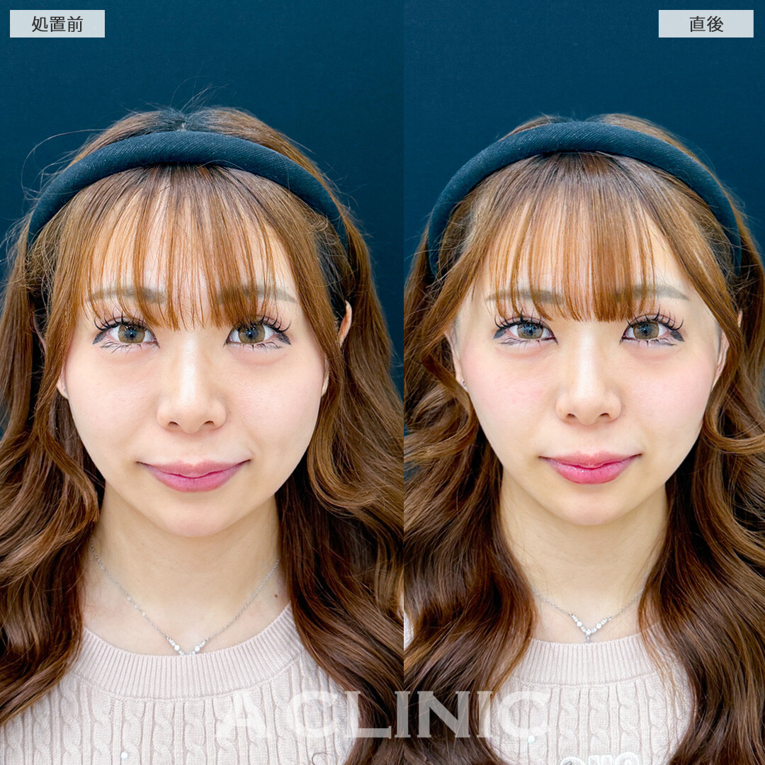 Aスレッドなら強力にリフトアップして直後から綺麗な仕上がりに！こちら処置前と直後の症例です(20代女性)