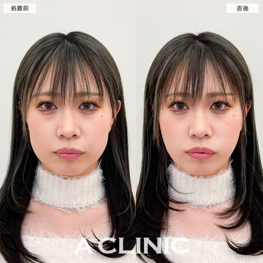 Aスレッドで理想の卵形フェイスになれました！こちら処置前と直後の症例です(20代女性)