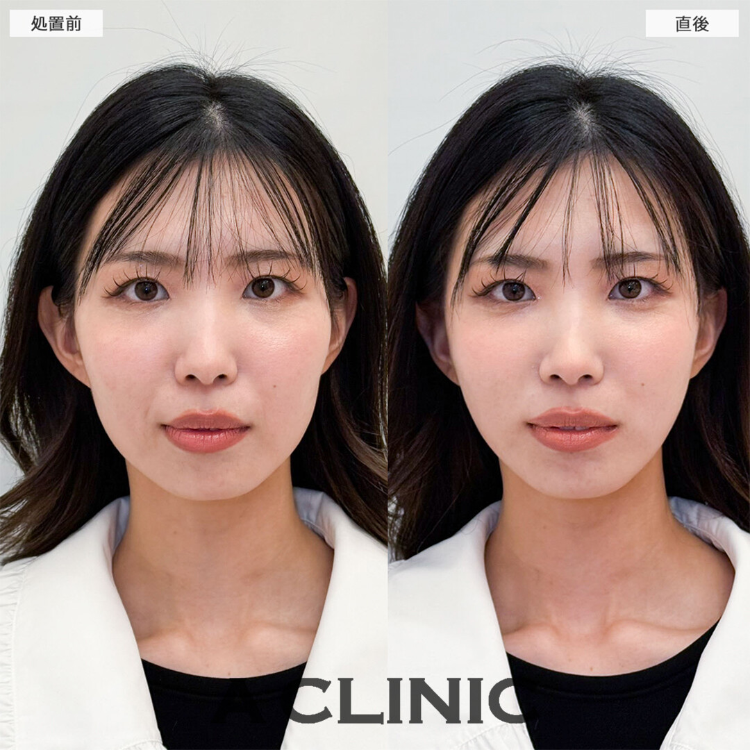 Aスレッドで左右差や口横のたるみが解消！こちら処置前と直後の症例です(30代女性)