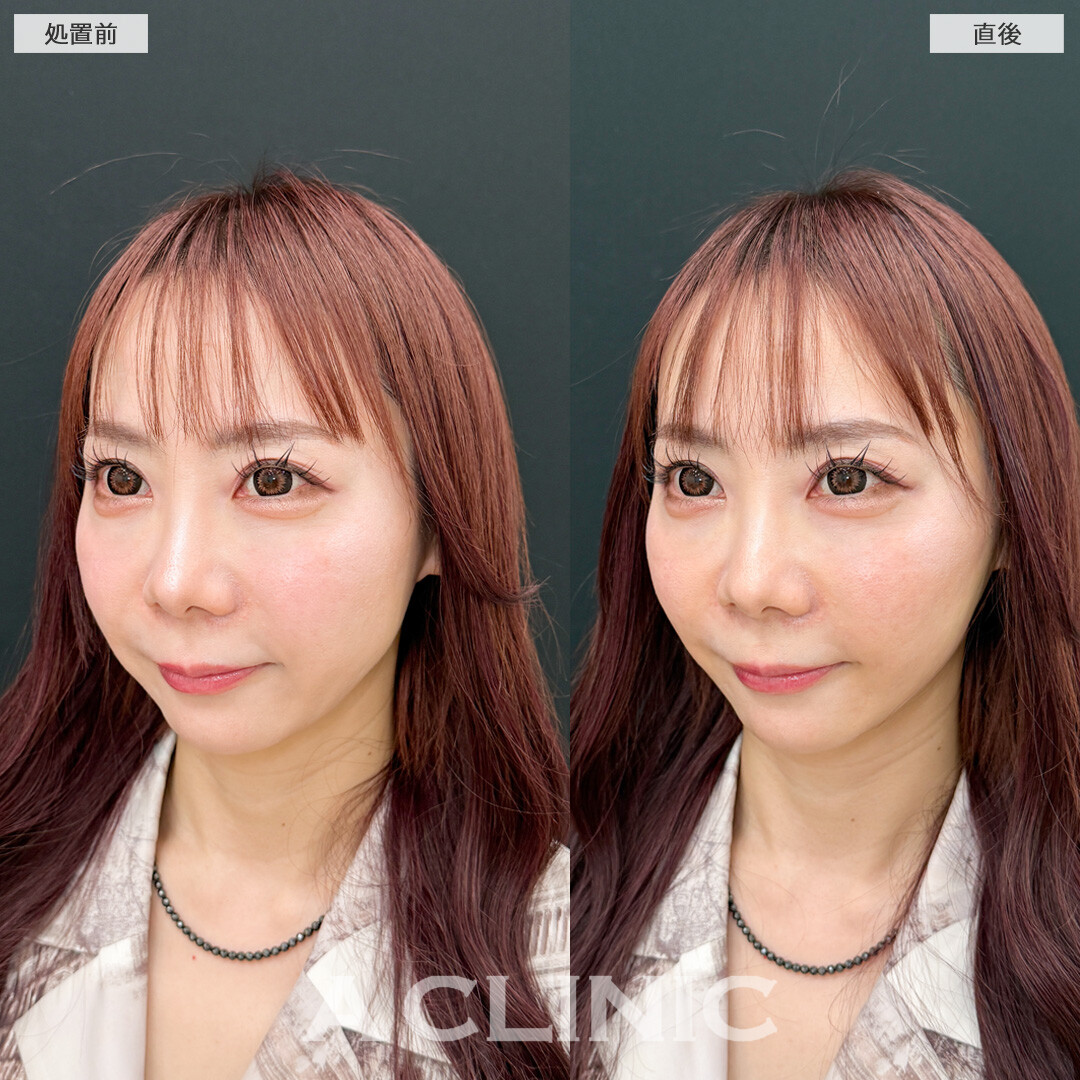 Aスレッドでフェイスラインを強力リフトアップしてクッキリ輪郭に！こちら処置前と直後の症例です(30代女性)