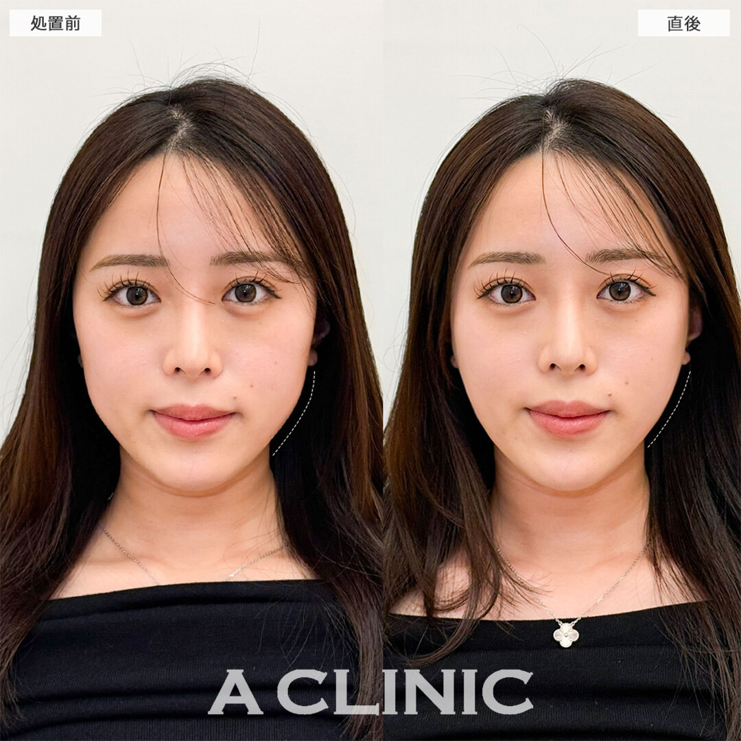 Aスレッドはたったの15分で口横のもたつき解消！こちら処置前と直後の症例です(20代女性)
