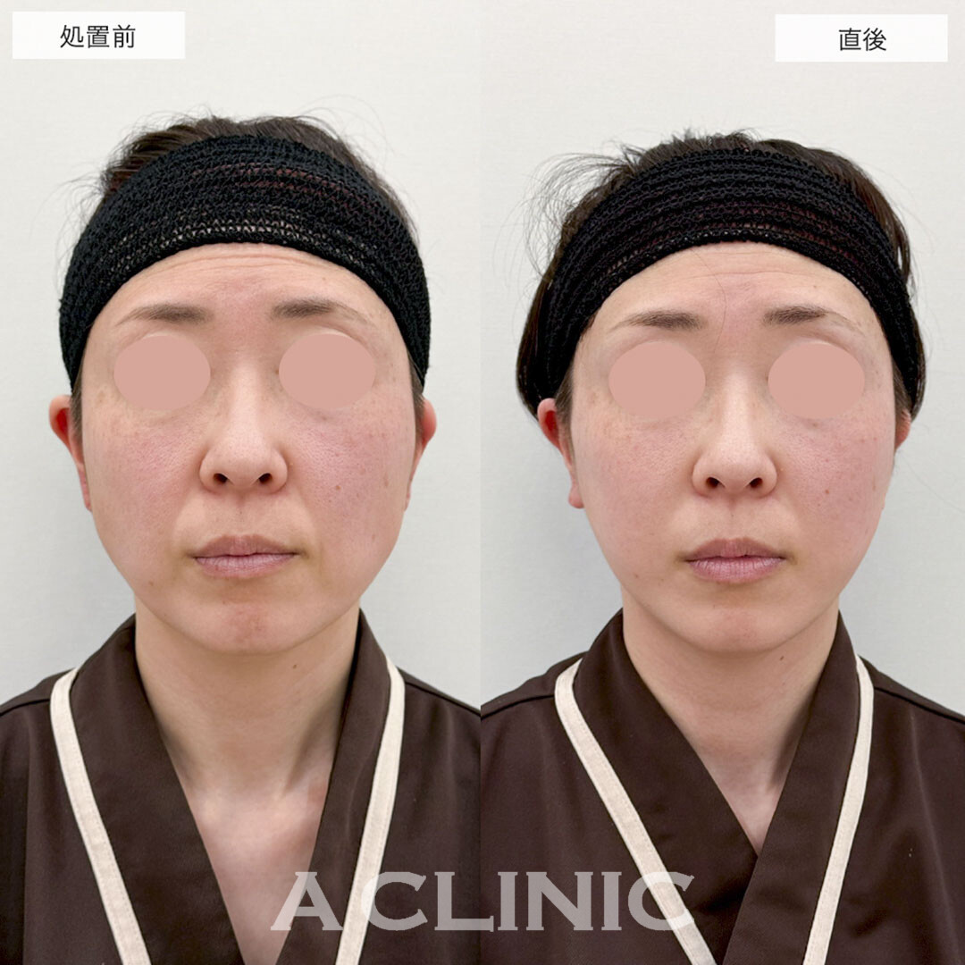 Aスレッドでほうれい線を引き上げて若見え効果!こちら処置前と直後の症例です(40代女性)