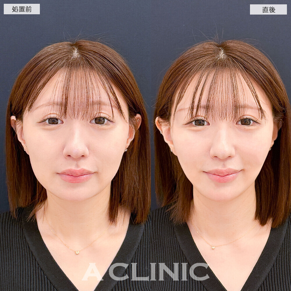 Aスレッドで1day小顔後のメンテナンスで更にリフトアップ！こちら処置前と直後の症例です(30代女性)