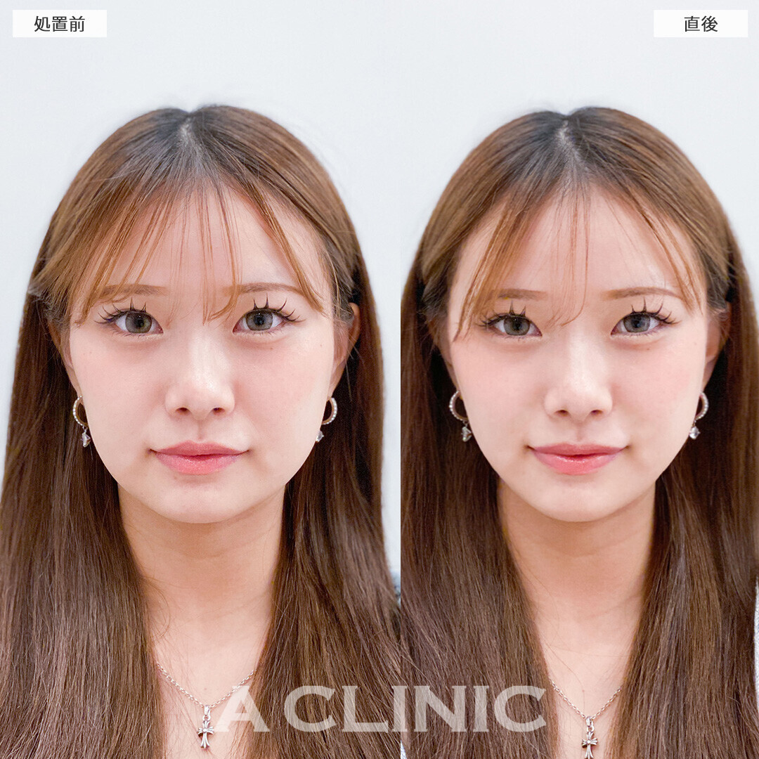 Aスレッドで丸顔解消されました！こちら処置前と直後の症例です(10代女性)