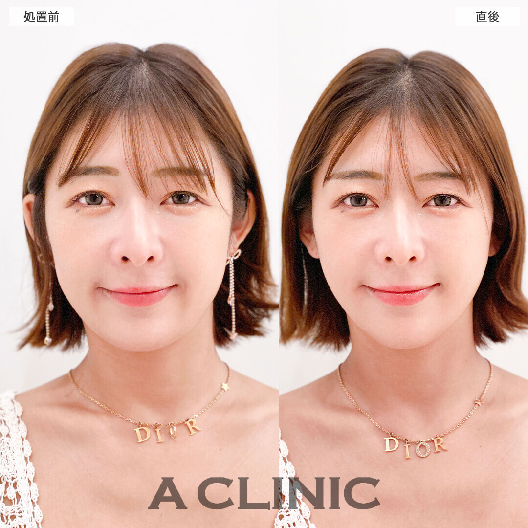 Aスレッドでフェイスラインが滑らかになりました！こちら処置前と直後の症例です(20代女性)