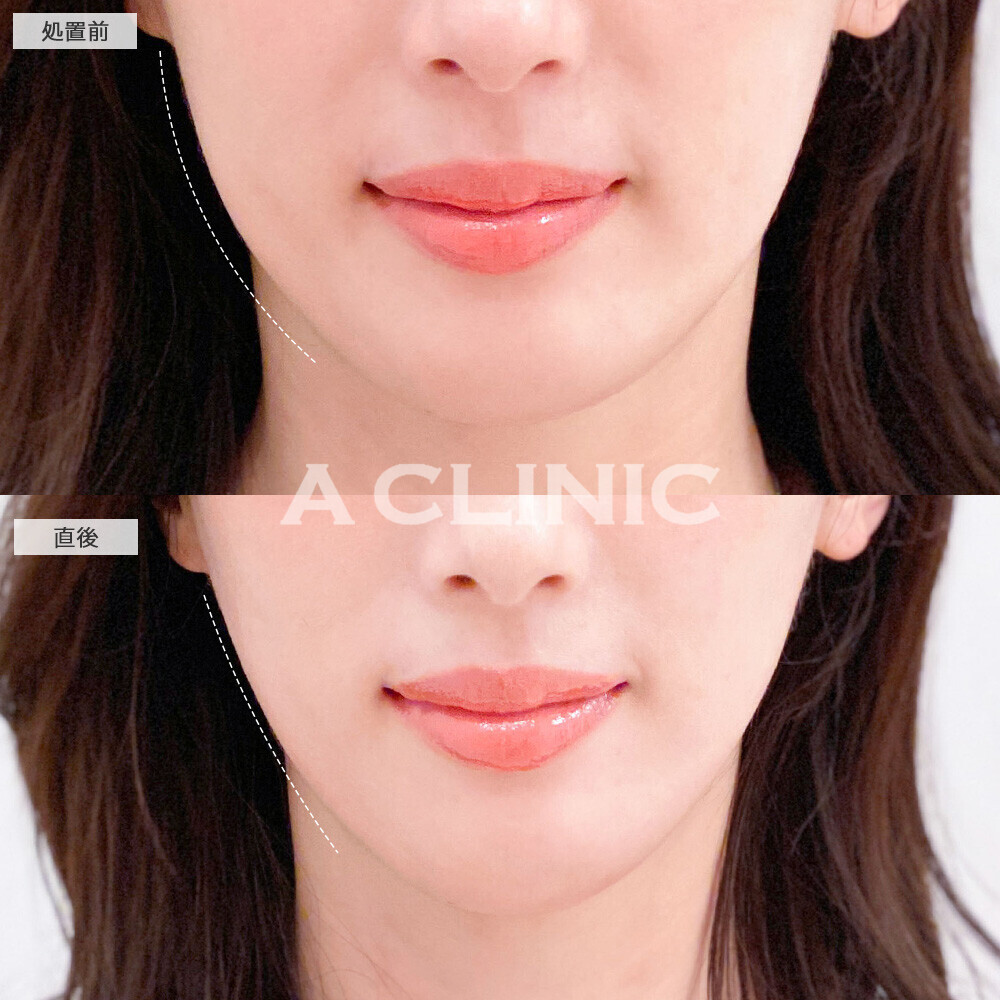 Aスレッドで少しのたるみも逃さずしっかりリフトアップ！こちら処置前と直後の症例です(30代女性)