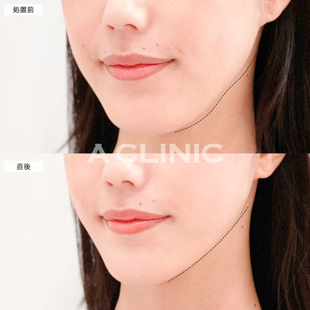 Aスレッドで小顔が更に小顔に！こちら処置前と直後の症例です(20代女性)