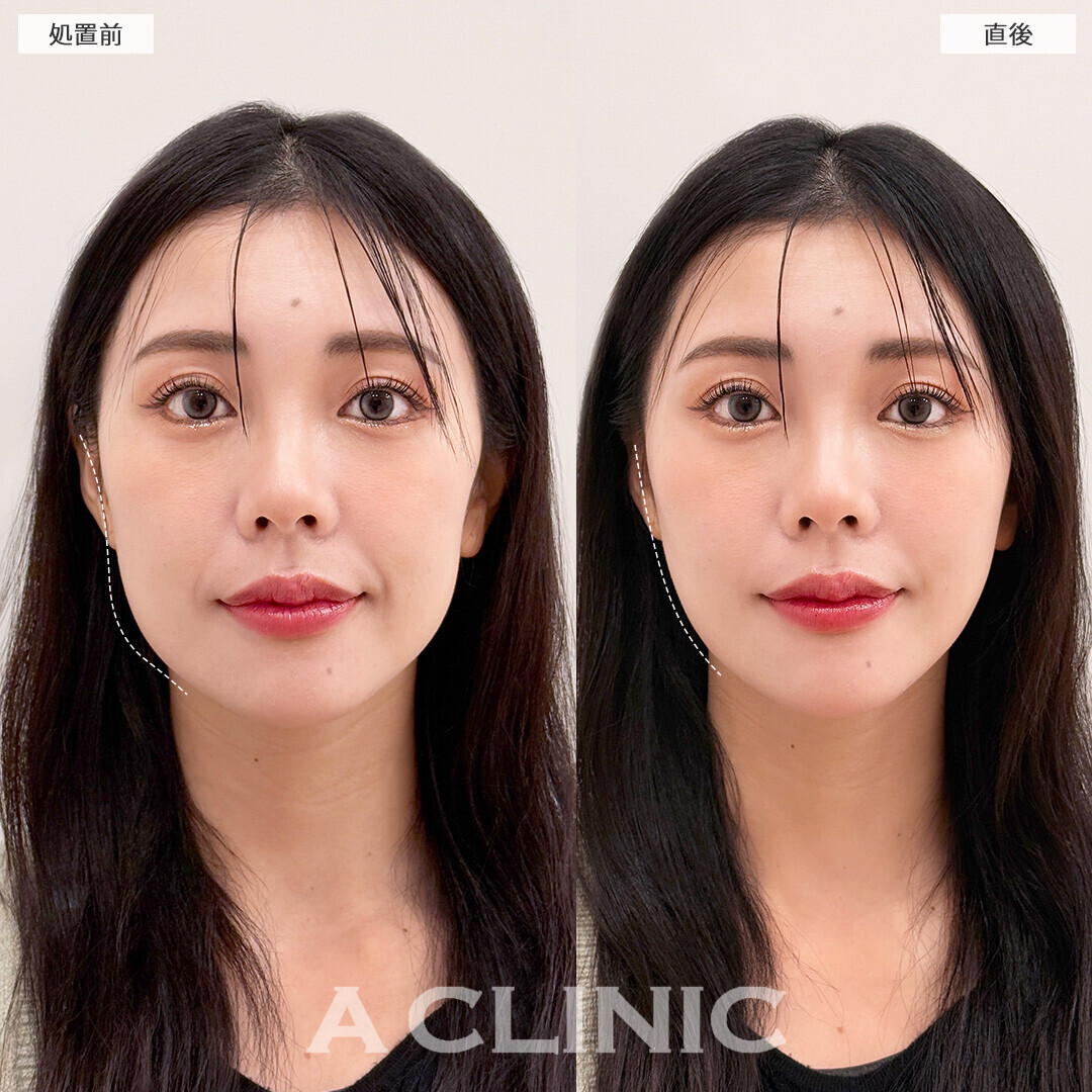 Aスレッドで輪郭の凹凸が整いました！こちら処置前と直後の症例です(30代女性)