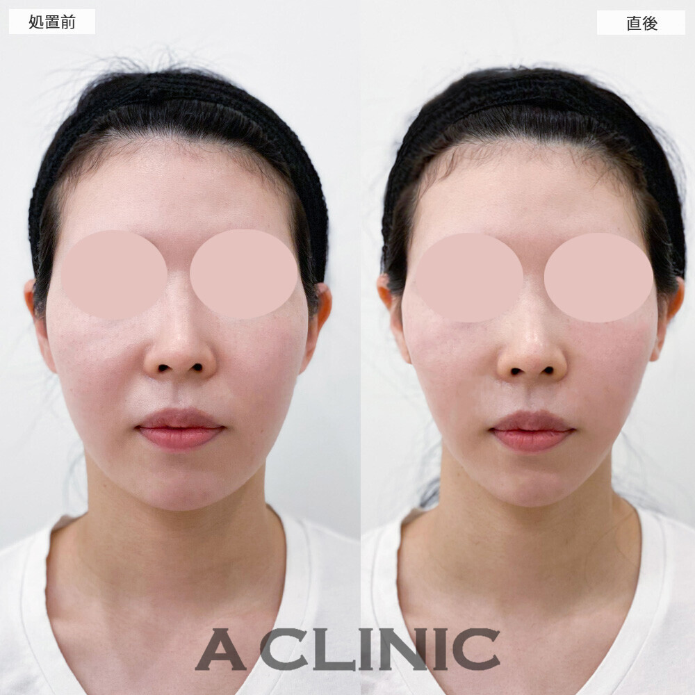 Aスレッドでメリハリがなかった輪郭がアゴにかけてシュッとしました！こちら処置前と直後の症例です(20代女性)