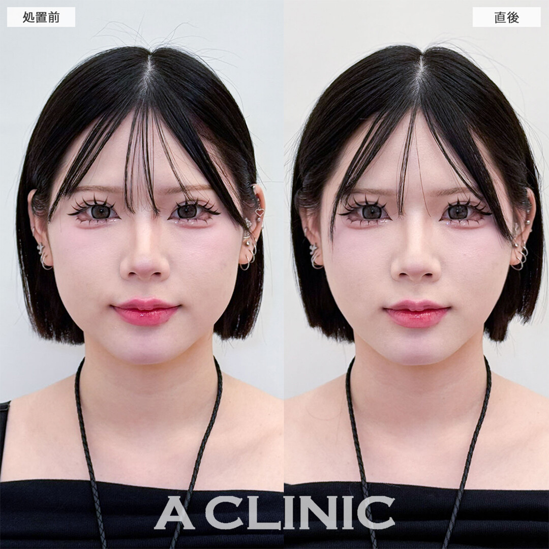 Aスレッドは施術直後から卵形フェイスになれます！こちら処置前と直後の症例です(20代女性)