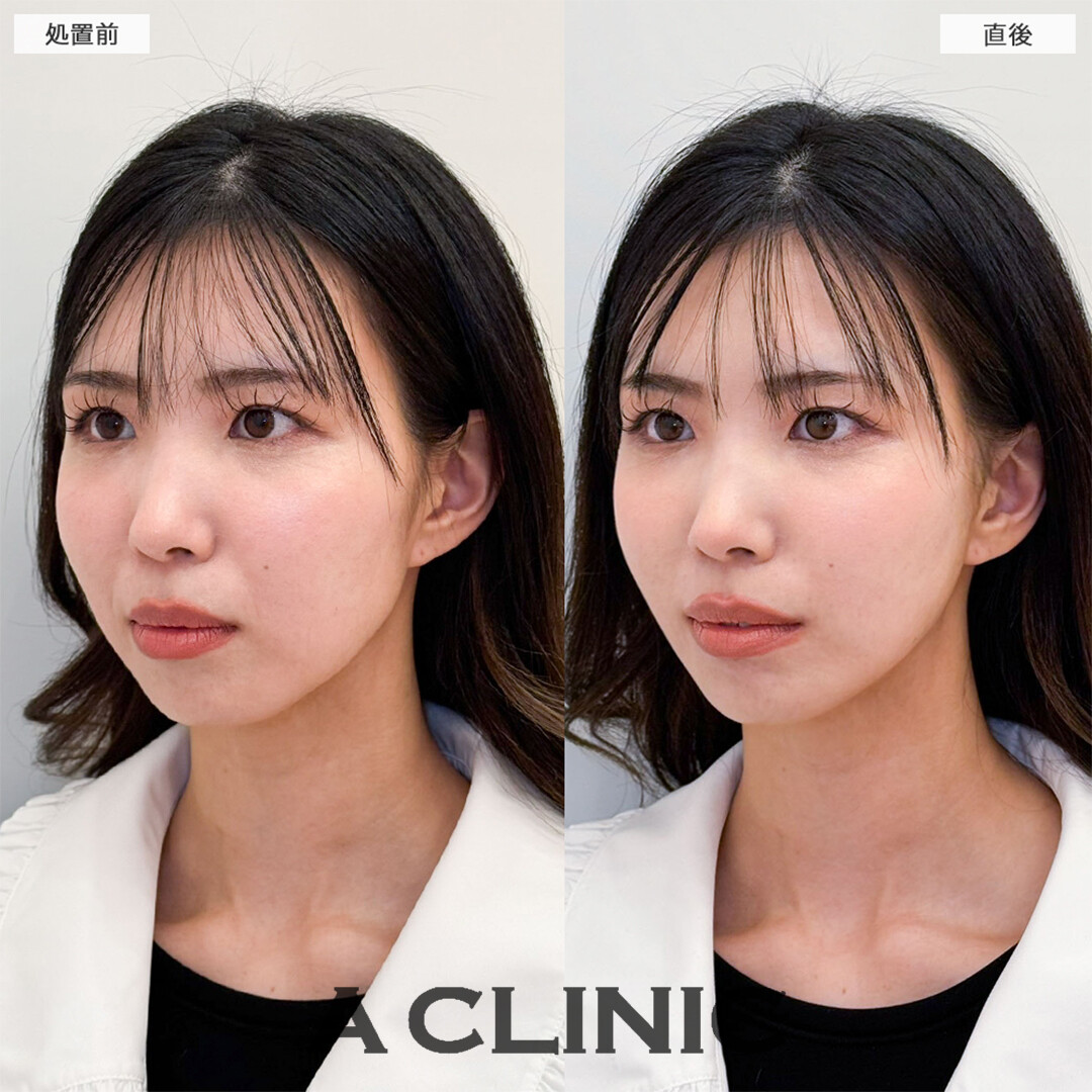Aスレッドで左右差や口横のたるみが解消！こちら処置前と直後の症例です(30代女性)