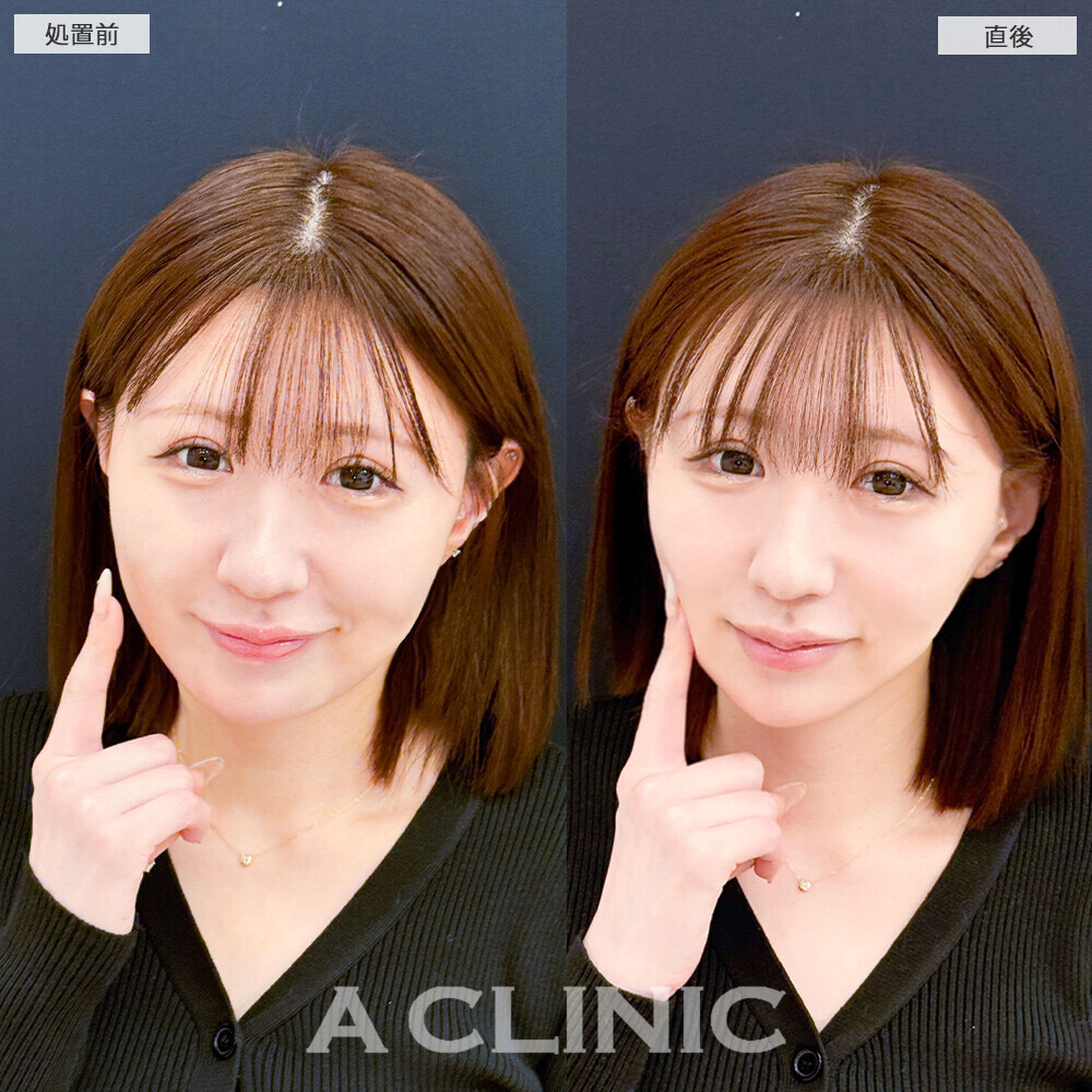 Aスレッドで1day小顔後のメンテナンスで更にリフトアップ！こちら処置前と直後の症例です(30代女性)