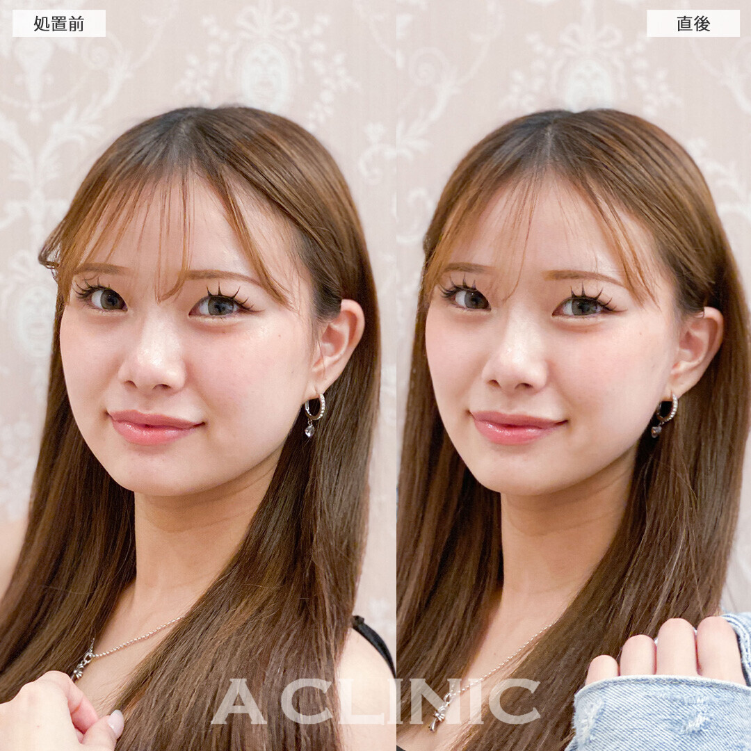 Aスレッドで丸顔解消されました！こちら処置前と直後の症例です(10代女性)