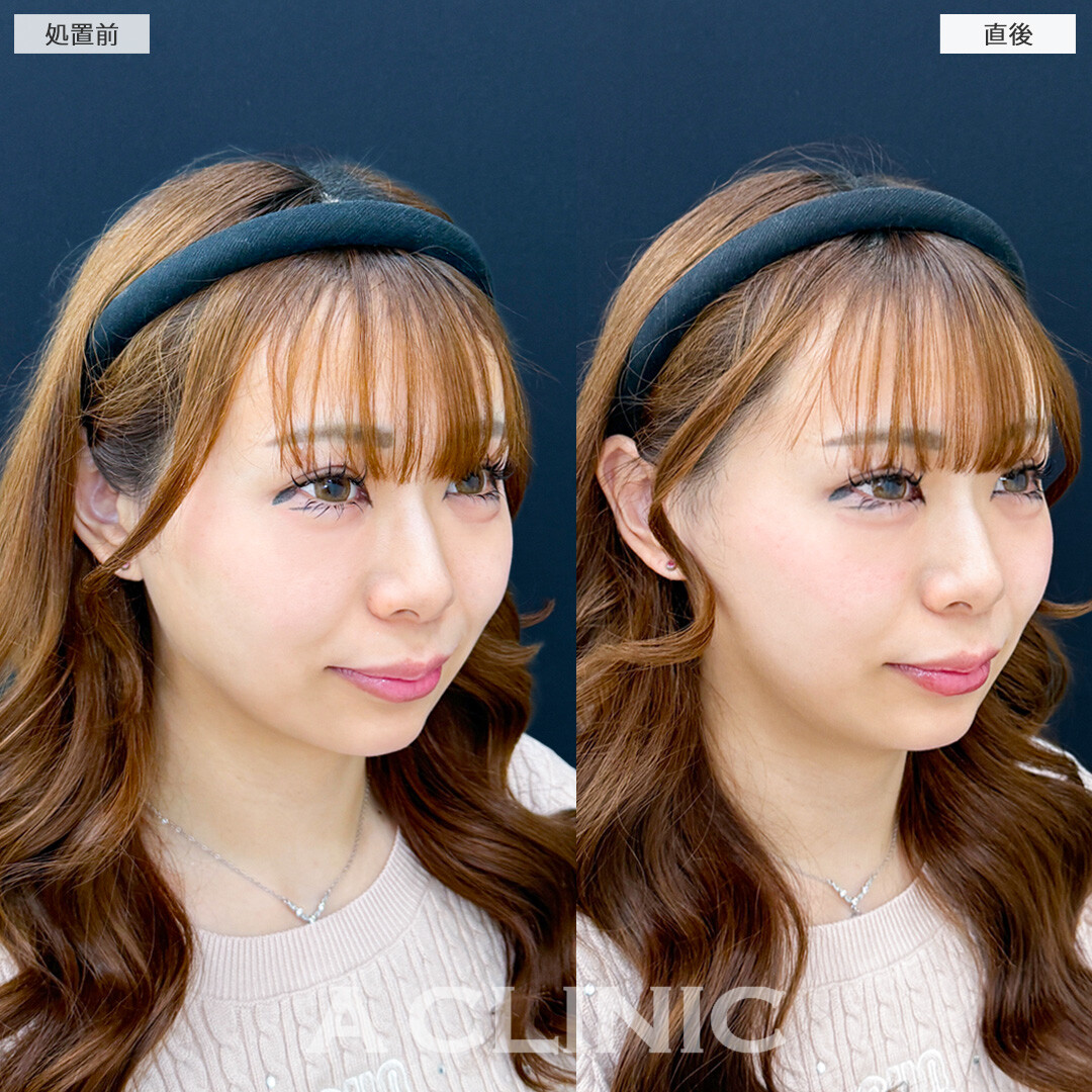 Aスレッドなら強力にリフトアップして直後から綺麗な仕上がりに！こちら処置前と直後の症例です(20代女性)