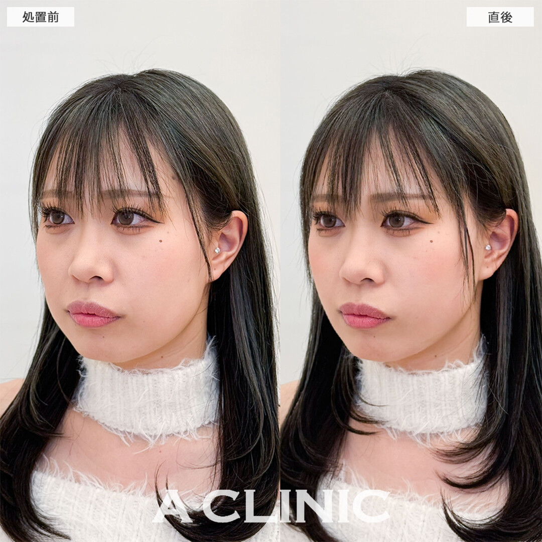 Aスレッドで理想の卵形フェイスになれました！こちら処置前と直後の症例です(20代女性)